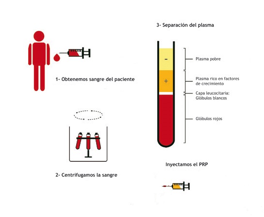 Terapia Con Plasma Rico en Células Madre